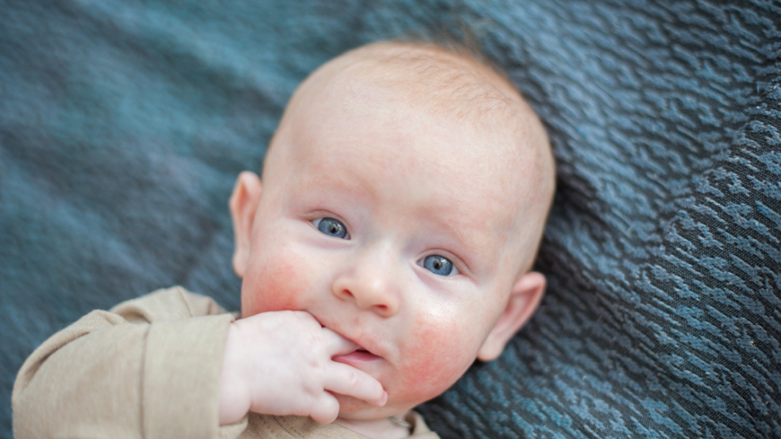 Böjveckseksem (atopiskt eksem)